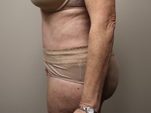Tummy Tuck After Photo by Kyle Shaddix, MD; Pensacola, FL - Case 36245
