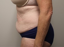 Tummy Tuck Before Photo by Kyle Shaddix, MD; Pensacola, FL - Case 36245