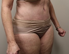 Tummy Tuck After Photo by Kyle Shaddix, MD; Pensacola, FL - Case 36245