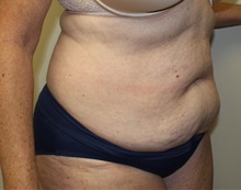 Tummy Tuck Before Photo by Kyle Shaddix, MD; Pensacola, FL - Case 36245