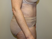 Tummy Tuck After Photo by Kyle Shaddix, MD; Pensacola, FL - Case 36245