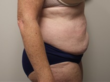 Tummy Tuck Before Photo by Kyle Shaddix, MD; Pensacola, FL - Case 36245
