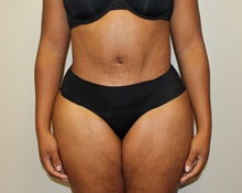 Tummy Tuck After Photo by Kyle Shaddix, MD; Pensacola, FL - Case 36246