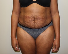 Tummy Tuck Before Photo by Kyle Shaddix, MD; Pensacola, FL - Case 36246