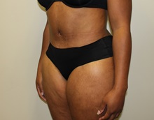 Tummy Tuck After Photo by Kyle Shaddix, MD; Pensacola, FL - Case 36246