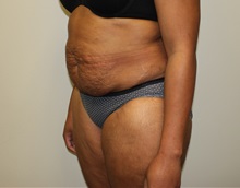 Tummy Tuck Before Photo by Kyle Shaddix, MD; Pensacola, FL - Case 36246