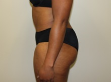 Tummy Tuck After Photo by Kyle Shaddix, MD; Pensacola, FL - Case 36246