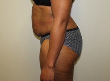 Tummy Tuck Before Photo by Kyle Shaddix, MD; Pensacola, FL - Case 36246