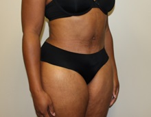 Tummy Tuck After Photo by Kyle Shaddix, MD; Pensacola, FL - Case 36246
