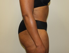Tummy Tuck After Photo by Kyle Shaddix, MD; Pensacola, FL - Case 36246