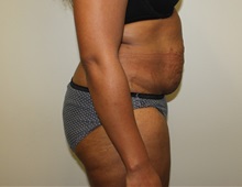 Tummy Tuck Before Photo by Kyle Shaddix, MD; Pensacola, FL - Case 36246