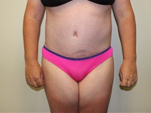 Tummy Tuck After Photo by Kyle Shaddix, MD; Pensacola, FL - Case 36247