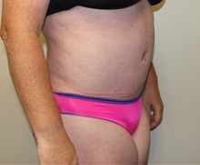 Tummy Tuck After Photo by Kyle Shaddix, MD; Pensacola, FL - Case 36247