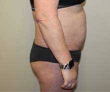 Tummy Tuck Before Photo by Kyle Shaddix, MD; Pensacola, FL - Case 36247