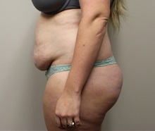 Tummy Tuck Before Photo by Kyle Shaddix, MD; Pensacola, FL - Case 36248