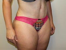 Tummy Tuck After Photo by Kyle Shaddix, MD; Pensacola, FL - Case 36248