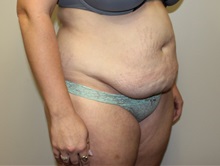 Tummy Tuck Before Photo by Kyle Shaddix, MD; Pensacola, FL - Case 36248