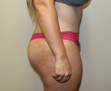 Tummy Tuck After Photo by Kyle Shaddix, MD; Pensacola, FL - Case 36248