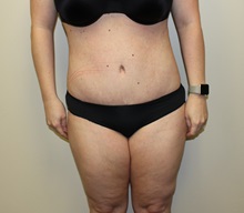 Tummy Tuck After Photo by Kyle Shaddix, MD; Pensacola, FL - Case 36251