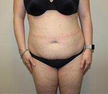 Tummy Tuck Before Photo by Kyle Shaddix, MD; Pensacola, FL - Case 36251