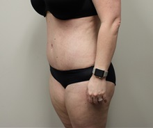 Tummy Tuck After Photo by Kyle Shaddix, MD; Pensacola, FL - Case 36251