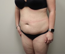 Tummy Tuck Before Photo by Kyle Shaddix, MD; Pensacola, FL - Case 36251