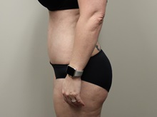 Tummy Tuck After Photo by Kyle Shaddix, MD; Pensacola, FL - Case 36251