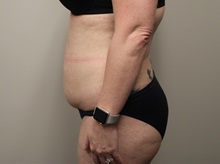 Tummy Tuck Before Photo by Kyle Shaddix, MD; Pensacola, FL - Case 36251