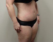 Tummy Tuck After Photo by Kyle Shaddix, MD; Pensacola, FL - Case 36251