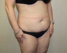 Tummy Tuck Before Photo by Kyle Shaddix, MD; Pensacola, FL - Case 36251