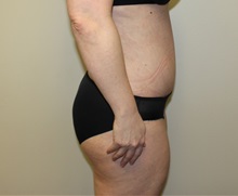 Tummy Tuck After Photo by Kyle Shaddix, MD; Pensacola, FL - Case 36251