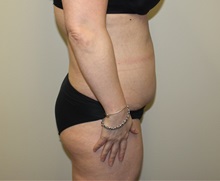 Tummy Tuck Before Photo by Kyle Shaddix, MD; Pensacola, FL - Case 36251