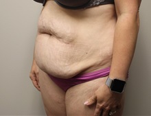 Tummy Tuck Before Photo by Kyle Shaddix, MD; Pensacola, FL - Case 36252