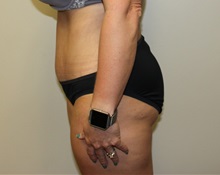 Tummy Tuck After Photo by Kyle Shaddix, MD; Pensacola, FL - Case 36252