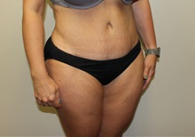 Tummy Tuck After Photo by Kyle Shaddix, MD; Pensacola, FL - Case 36252