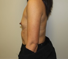 Breast Augmentation Before Photo by Kyle Shaddix, MD; Pensacola, FL - Case 36273