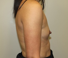 Breast Augmentation Before Photo by Kyle Shaddix, MD; Pensacola, FL - Case 36273