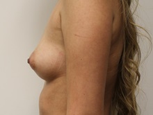 Breast Augmentation Before Photo by Kyle Shaddix, MD; Pensacola, FL - Case 36286