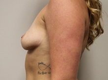 Breast Augmentation Before Photo by Kyle Shaddix, MD; Pensacola, FL - Case 36291