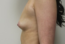Breast Augmentation Before Photo by Kyle Shaddix, MD; Pensacola, FL - Case 36295