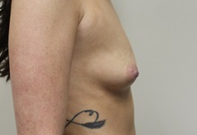 Breast Augmentation Before Photo by Kyle Shaddix, MD; Pensacola, FL - Case 36295