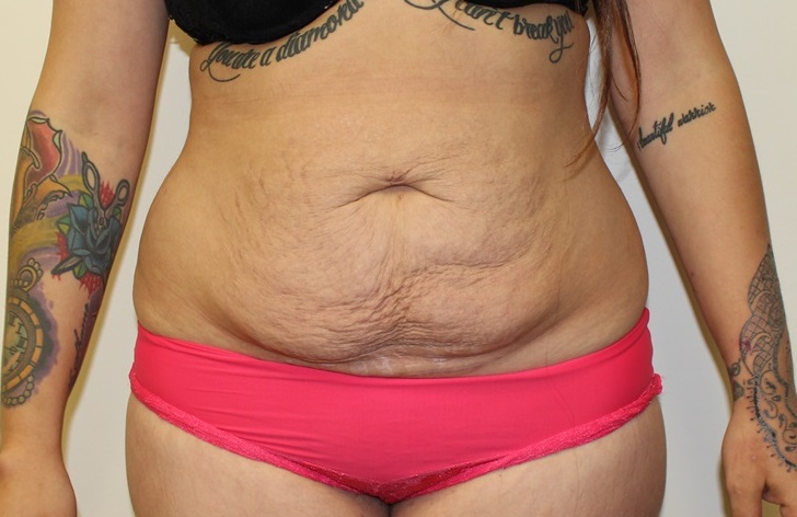 Tummy Tuck Before and After Photos by Kyle Shaddix, MD; Pensacola, FL -  Case 36302