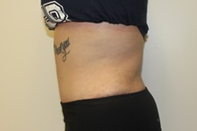 Tummy Tuck After Photo by Kyle Shaddix, MD; Pensacola, FL - Case 36302