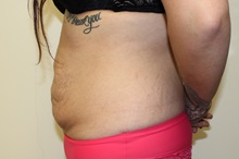 Tummy Tuck Before Photo by Kyle Shaddix, MD; Pensacola, FL - Case 36302