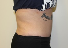 Tummy Tuck After Photo by Kyle Shaddix, MD; Pensacola, FL - Case 36302