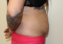 Tummy Tuck Before Photo by Kyle Shaddix, MD; Pensacola, FL - Case 36302