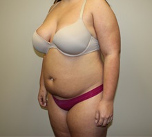 Liposuction Before Photo by Kyle Shaddix, MD; Pensacola, FL - Case 36303