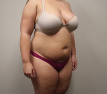 Liposuction Before Photo by Kyle Shaddix, MD; Pensacola, FL - Case 36303