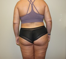 Liposuction After Photo by Kyle Shaddix, MD; Pensacola, FL - Case 36303