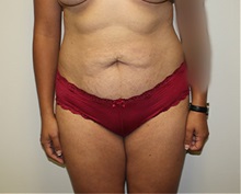 Tummy Tuck Before Photo by Kyle Shaddix, MD; Pensacola, FL - Case 36304